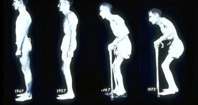 ankilozan spondilit ve omurga yapısının zamanla değişimi